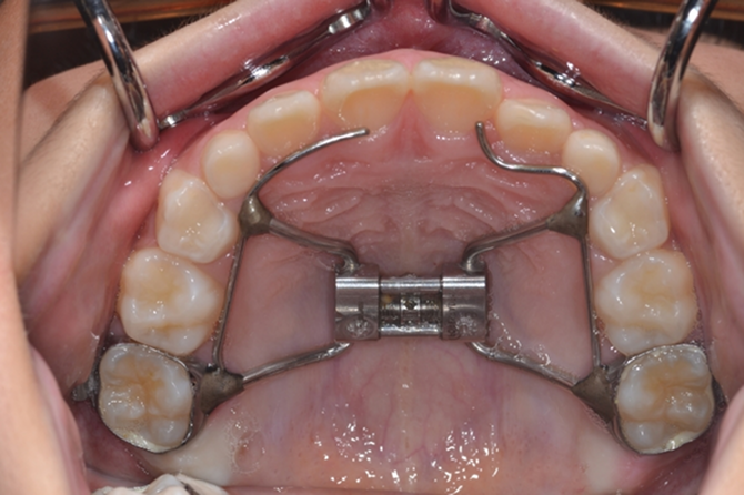 急速拡大治療法​​